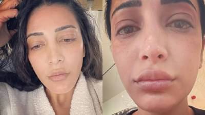 Shruti Haasan | श्रुती हासन हिचे हे फोटो पाहून चाहत्यांमध्ये चिंतेचे वातावरण, वाचा नेमके काय घडले?