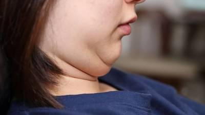 डबल चिनमुळे त्रासलात ? हा व्यायाम ठरेल फायदेशीर