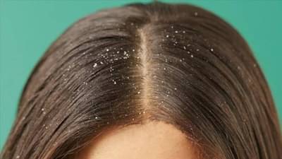 Dandruff Diet Tips: हिवाळ्यात होत असेल कोंड्याचा त्रास, तर आजपासूनच करा या पदार्थांचे सेवन
