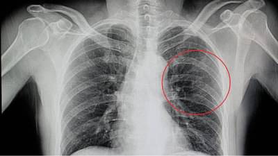 तिखट खाल्ल्याने हॉस्पिटलला जावं लागलं! बरगड्या तुटल्या, तुम्हालाही आवडतं का तिखट?