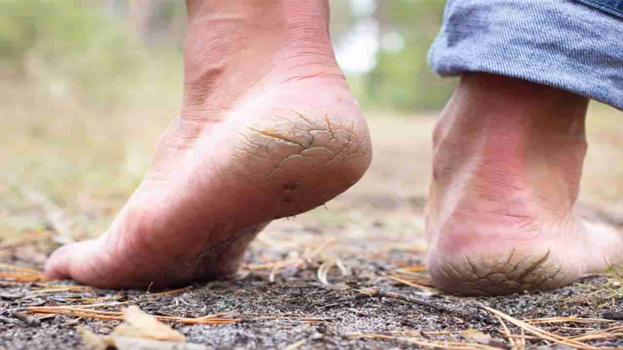 Cracked Heels Problems: थंडीत पायाच्या भेगांमुळे त्रासलात ? करा हे घरगुती उपाय