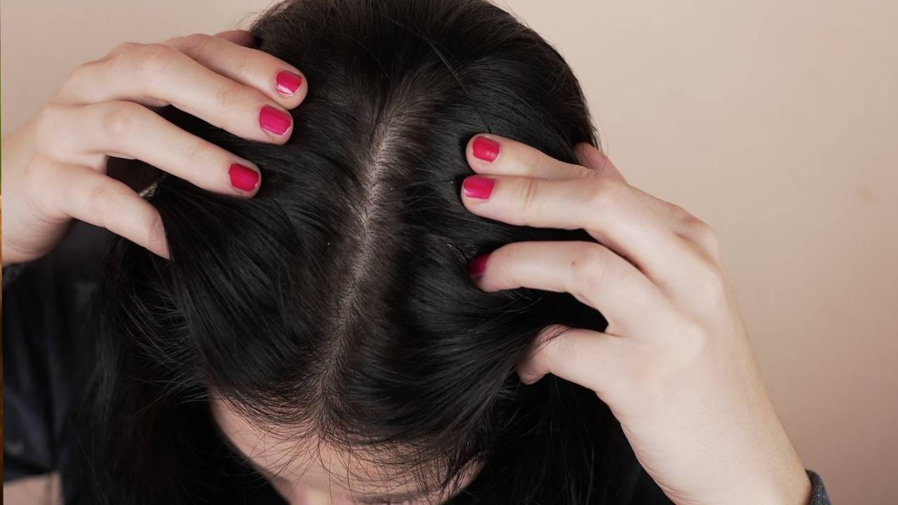 खोबरेल तेलाचा वापर केल्याने कोंड्याच्या समस्येपासून मुक्ती मिळते. हे तेल लावल्याने स्काल्पला सुटणारी खाज कमी होते. तसेच हानिकारक बॅक्टेरिया काढून टाकते.