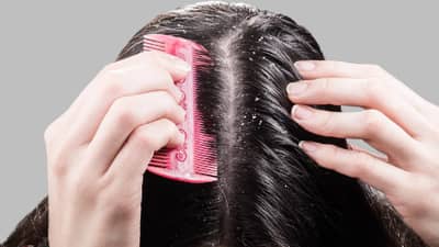 Ayurvedic Remedy: थंडीत कोंड्याचा त्रास कमी करण्यासाठी करून पहा हे आयुर्वेदिक उपाय