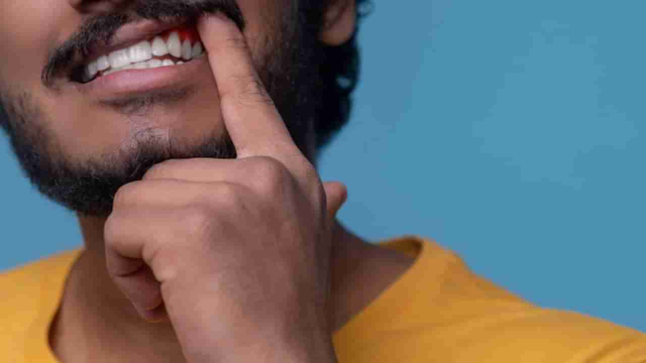 Gum Bleeding Remedies:तुमच्याही हिरड्यांमधून रक्त येते का ? या घरगुती उपायांनी मिळू शकेल आराम