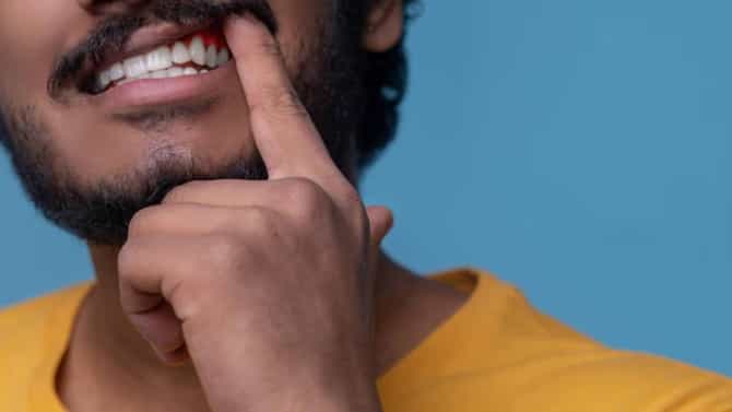 Gum Bleeding Remedies:तुमच्याही हिरड्यांमधून रक्त येते का ? या घरगुती उपायांनी मिळू शकेल आराम
