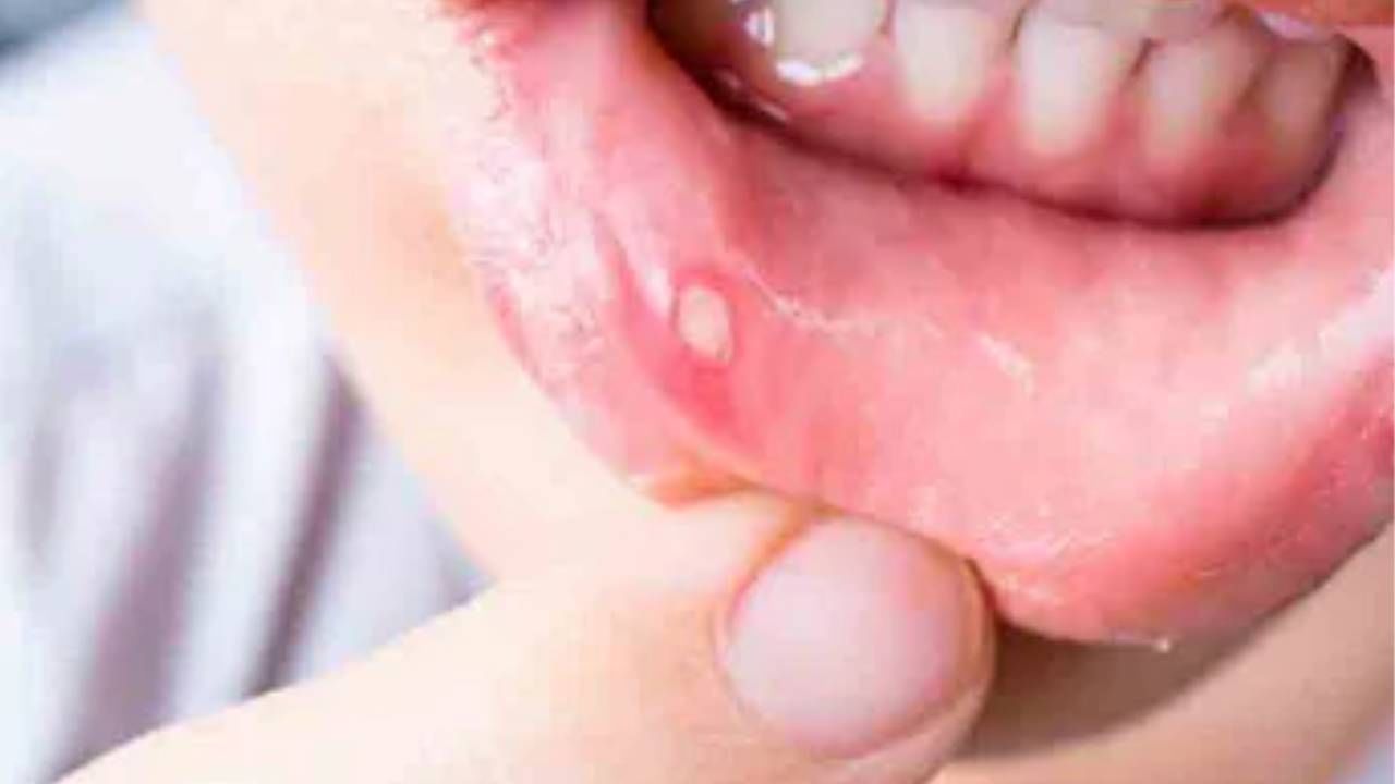 Mouth Ulcers Remedies : तोंडात वारंवार येणाऱ्या फोडांमुळे वैतागलात ? या घरगुती उपायांनी मिळू शकेल आर