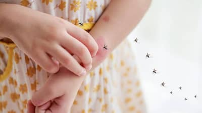 Mosquito Bite : एक मच्छर आदमी को... मच्छर चावल्यावर त्वचा का सूजते माहित्ये का?; कारण लैच भारी हाय