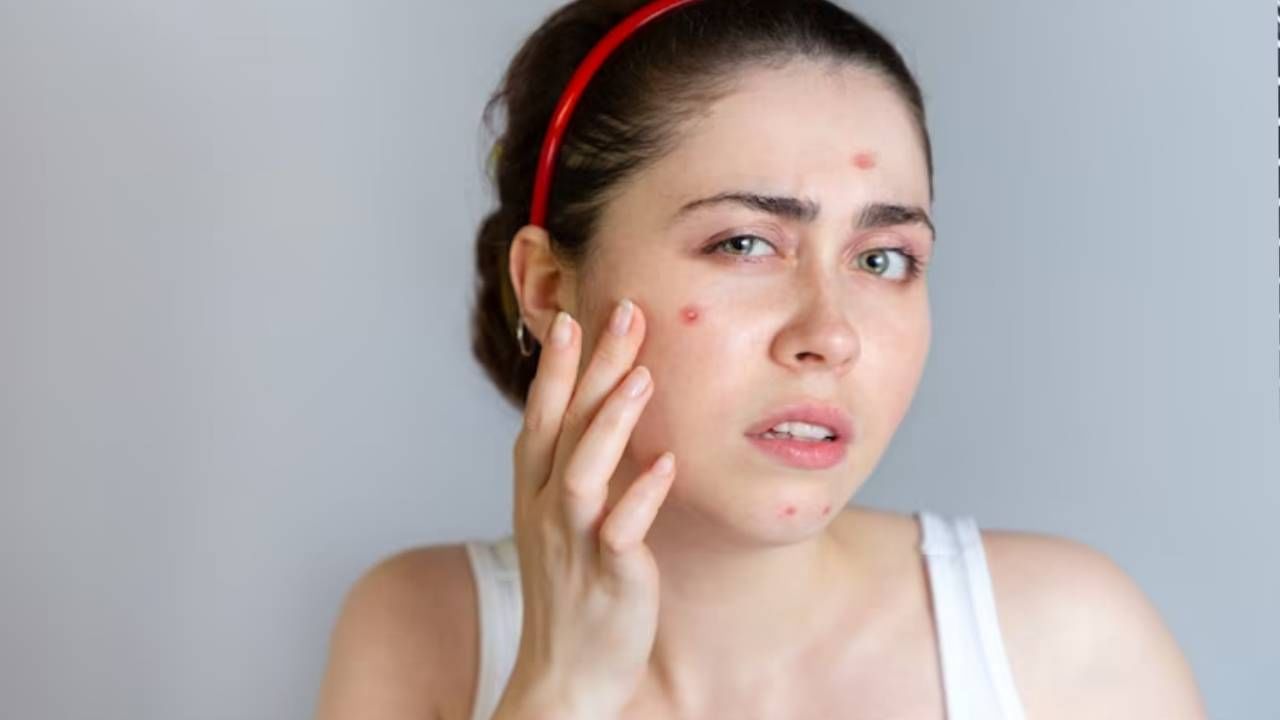 पिंपल्स पाठ सोडत नाहीयेत ? एकदा ट्राय करून बघा दालचिनीचा फेसपॅक पिंपल्स पाठ सोडत नाहीयेत ? एकदा ट्राय करून बघा दालचिनीचा फेसपॅक