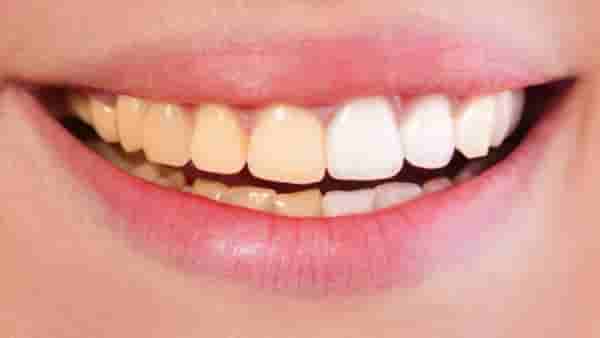 Teeth : मोत्यासारखे चमकू लागतील पिवळे पडलेले दात, करा हे 3 घरगुती उपाय!