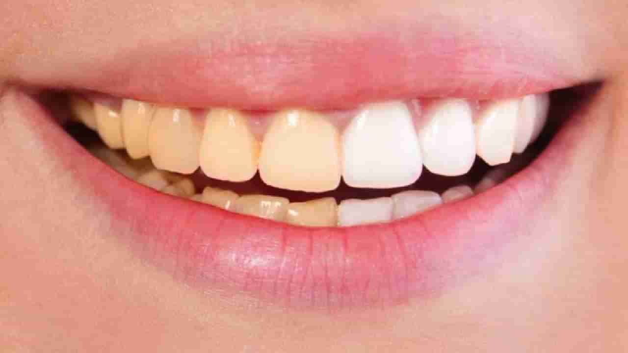 दातांचा पिवळेपणा कसा घालवणार? एकदम सोपे उपाय, वाचा