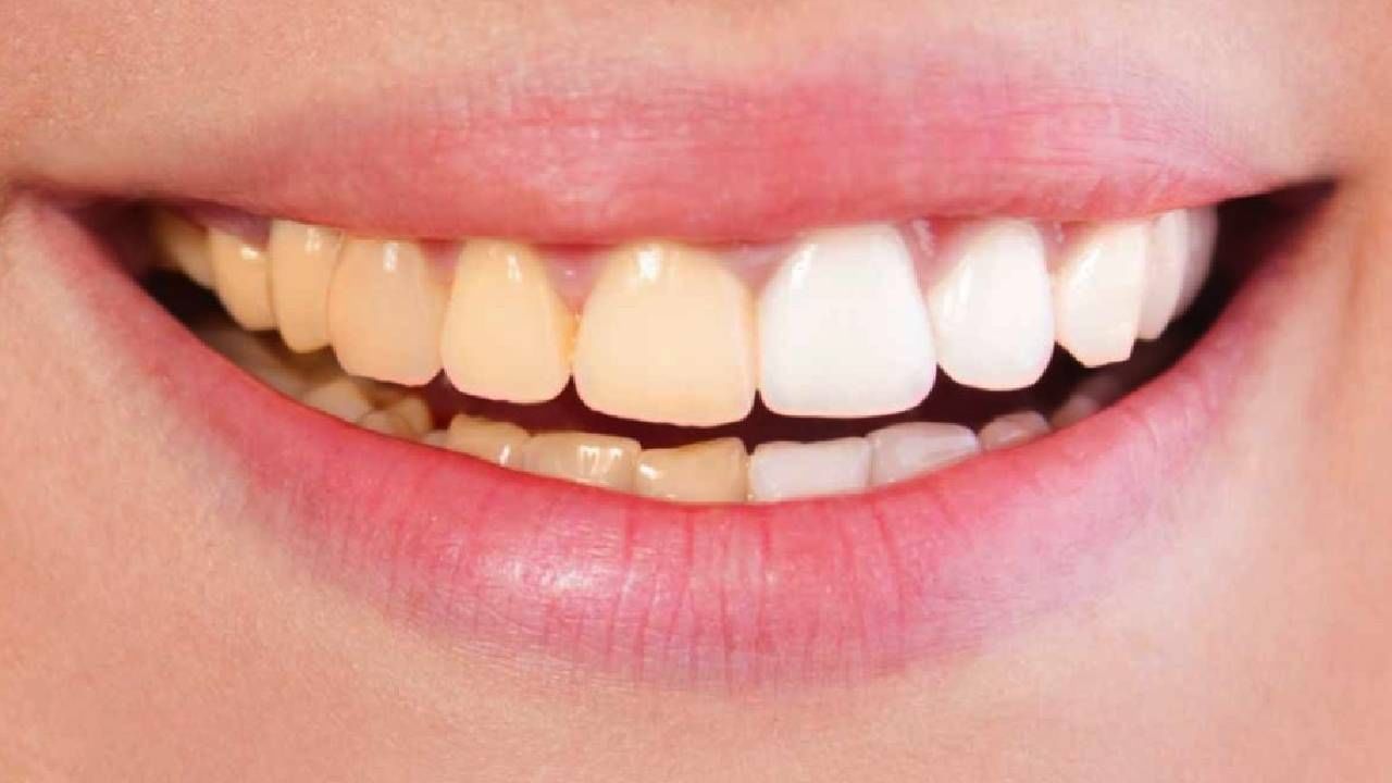 दातांचा पिवळेपणा कसा घालवणार? एकदम सोपे उपाय, वाचा