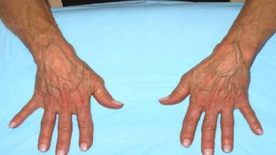 हातांवर शिरा दिसण्याची कारणे काय?