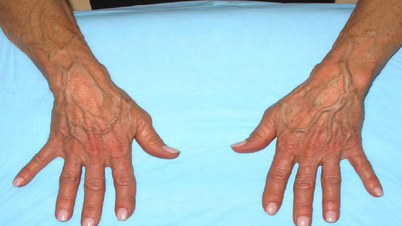 हातांवर शिरा दिसण्याची कारणे काय? हातांवर शिरा दिसण्याची कारणे काय?