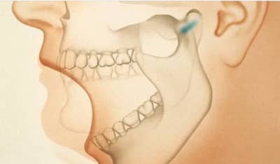 कॅन्सरने खराब झाला होता जबडा, डॉक्टरांनी पायाच्या हाडापासून बनवला नवा जबडा