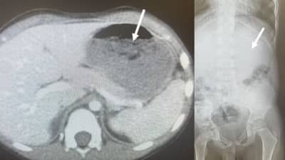 चार वर्षांच्या बालकाने गिळले 40 चुईंग गम, डॉक्टरांच्या प्रयत्नांनी वाचले प्राण