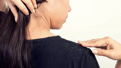 कोंडा दूर करायचे सोपे घरगुती उपाय!