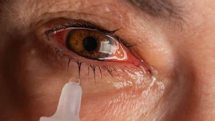 नागरिकांनो सावधान! महाराष्ट्रात डोळ्यांची साथ आलीय, जाणून घ्या लक्षणं आणि उपाय... नागरिकांनो सावधान! महाराष्ट्रात डोळ्यांची साथ आलीय, जाणून घ्या लक्षणं आणि उपाय...