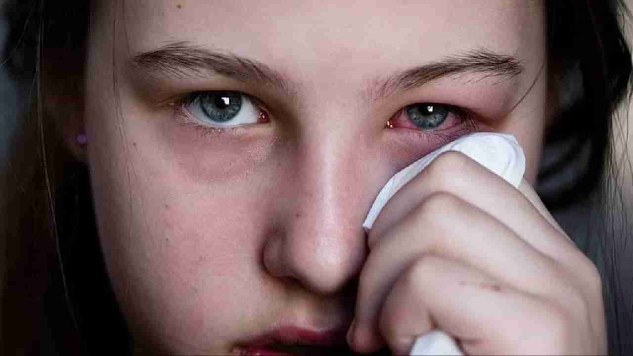 Eye Flu: डोळ्यांची साथ राज्यभर पसरली; ठाण्यात रुग्णांचा आकडा पाहिल्यानंतर आरोग्य विभागाने...