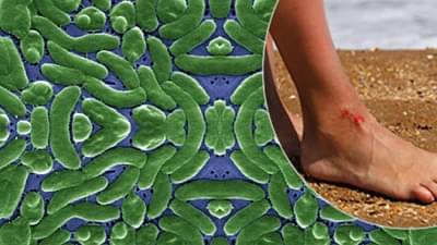 मांस खाणाऱ्या बॅक्टेरियामुळे तीन जणांचा मृत्यू; हा बॅक्टेरिया किती घातक?