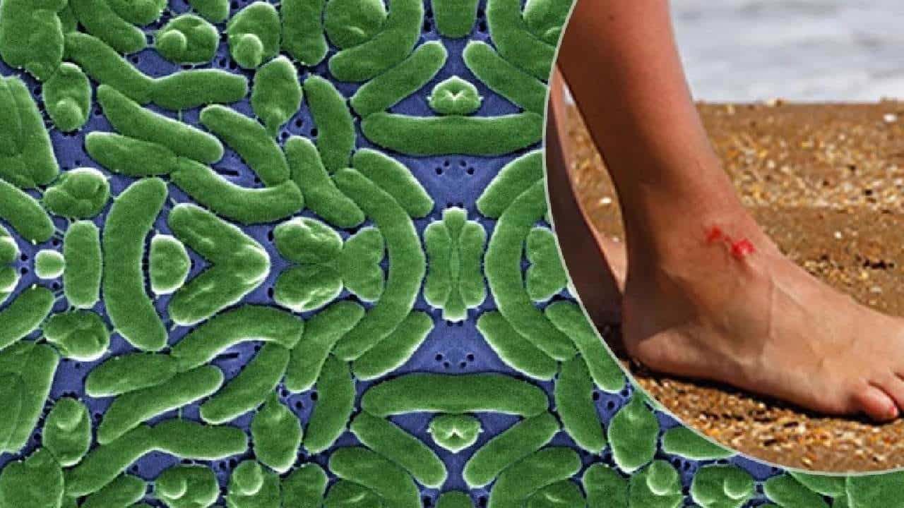 मांस खाणाऱ्या बॅक्टेरियामुळे तीन जणांचा मृत्यू; हा बॅक्टेरिया किती घातक?