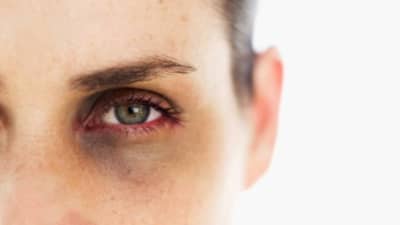 Dark Circles पासून सुटका कशी मिळवायची? हे आहेत घरगुती उपाय