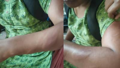 असं कुणी मारतं का?... शिक्षिकेची विद्यार्थीनीला हात सुजेपर्यंत बांबूने मारहाण...; नवी मुंबईतील धक्कादायक प्रकार