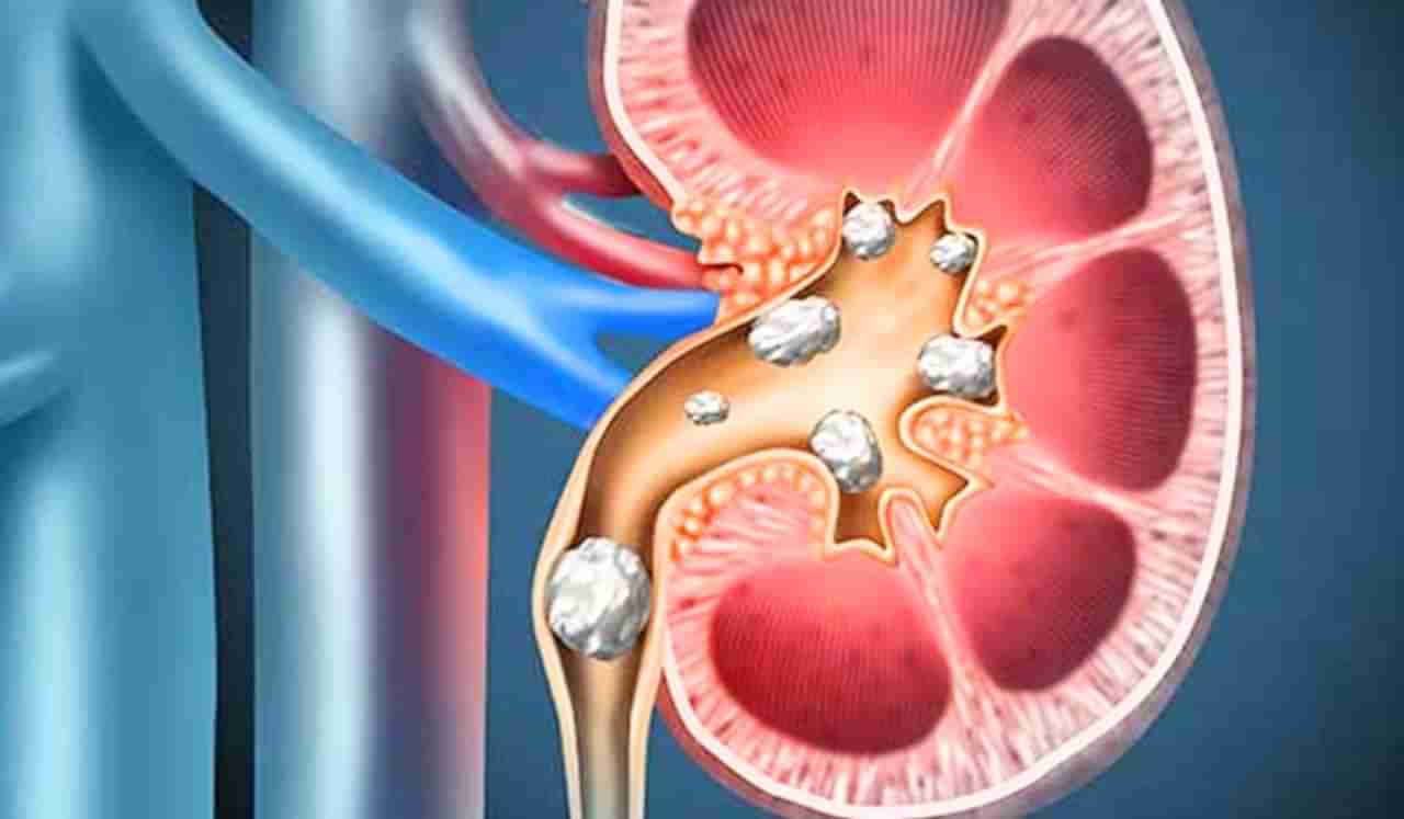 Kidney stone: किडनी स्टोनचा धोका कमी करतात या 5 गोष्टी