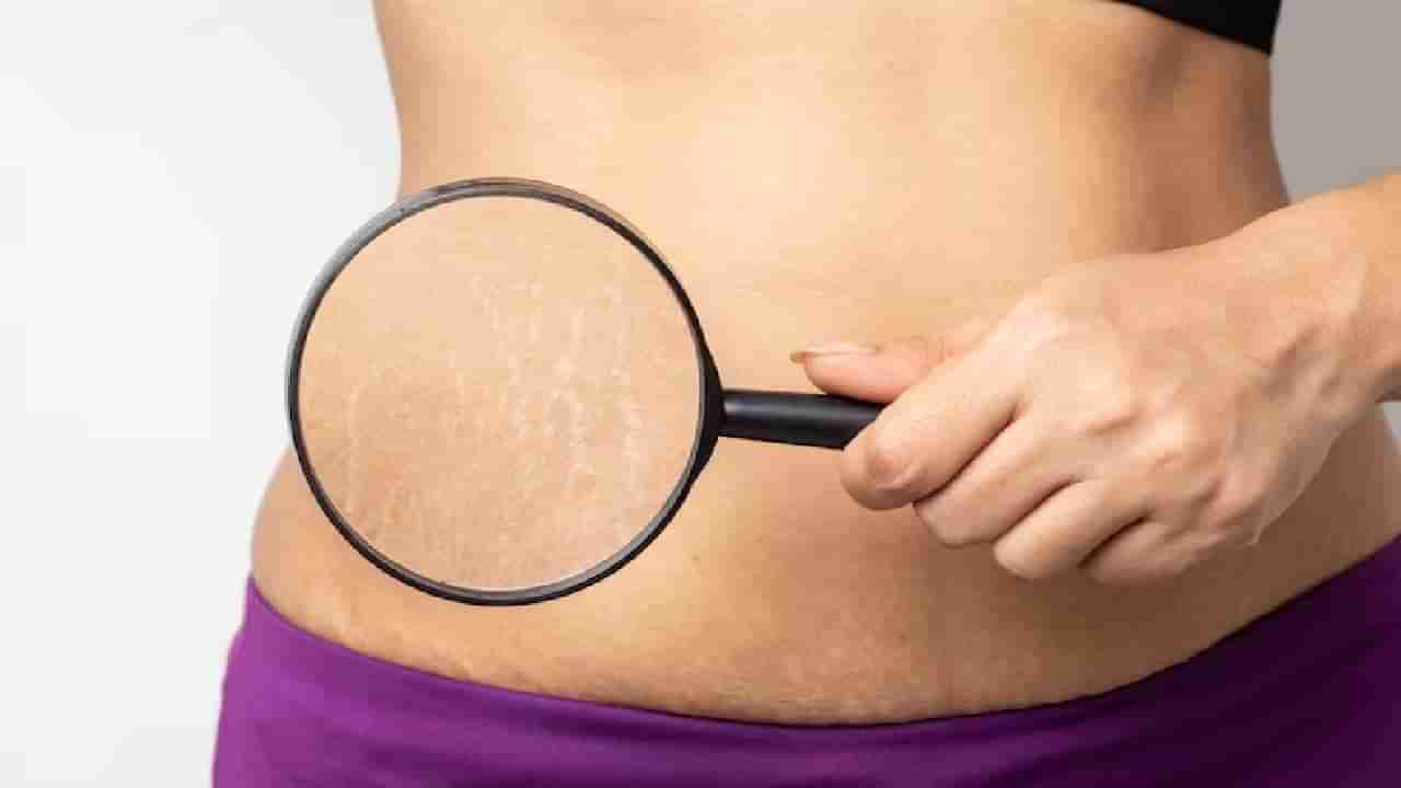 Stretch marks : स्ट्रेच मार्क्समुळे आहात हैराण ? या घरगुती उपायांनी मिळेल आराम