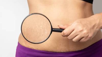 Stretch marks : स्ट्रेच मार्क्समुळे आहात हैराण ? या घरगुती उपायांनी मिळेल आराम