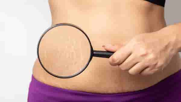 Stretch marks : स्ट्रेच मार्क्समुळे आहात हैराण ? या घरगुती उपायांनी मिळेल आराम