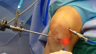 गुडघ्याच्या आर्थ्रोस्कोपीचे करण्याचे फायदे आणि का करावी जाणून घ्या