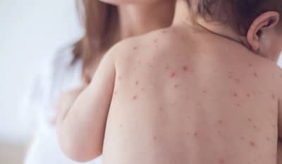 कांजिण्या येण्याचं प्रमाण वाढतंय, जाणून घ्या कसे कराल बचाव