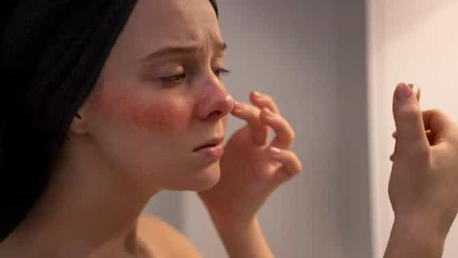 Skin Care : होळीच्या रंगामुळे त्वचा झाली लालेलाल ? या उपायांनी मिळेल त्वरित आराम