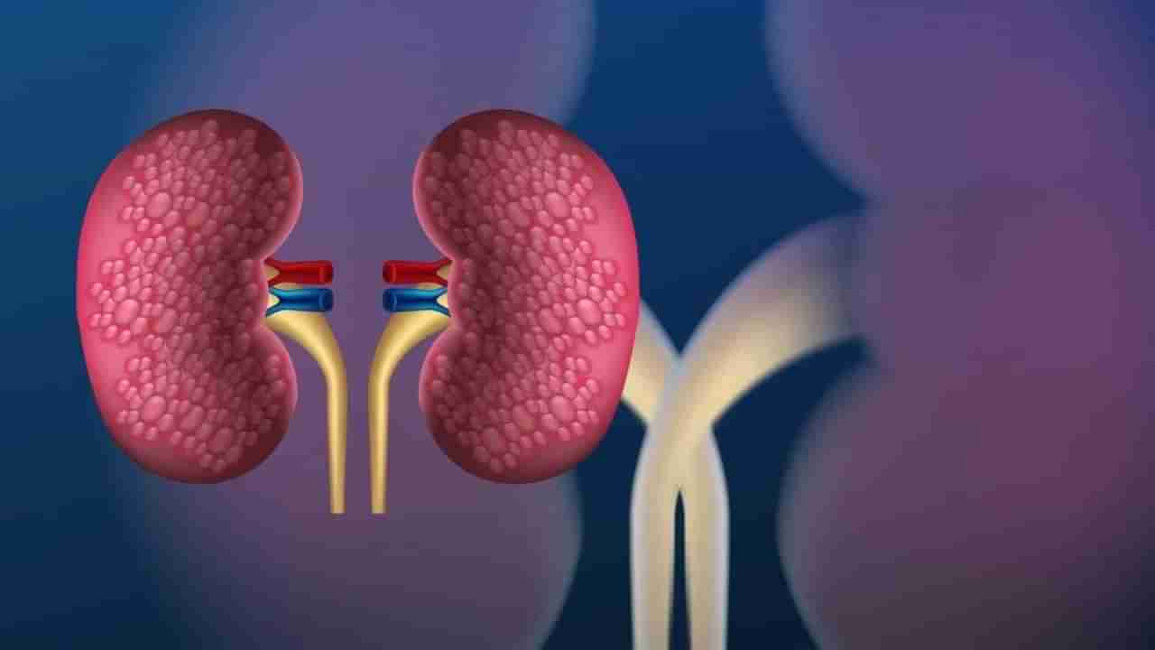 World Kidney Day 2024 | किडनीचे आरोग्य बिघडविणाऱ्या पाच वाईट सवयी कोणत्या ?