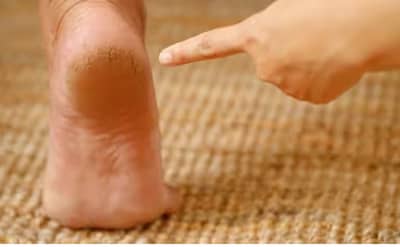 हिवाळ्यात पायांना भेगा पडतात, या ३ घरगुती टिप्स ठेवा लक्षात