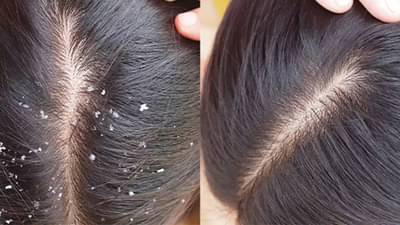 हिवाळ्यात का वाढते कोंड्याची समस्या? जाणून घ्या कारणे