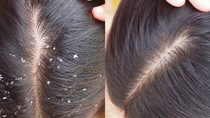 हिवाळ्यात का वाढते कोंड्याची समस्या? जाणून घ्या कारणे
