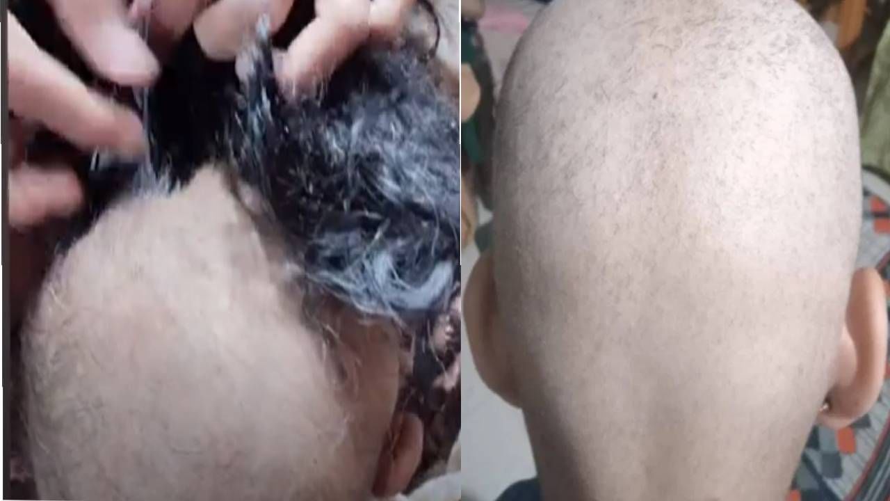 Buldhana Hair Loss Video : बुलढाण्यातील टकल्या लोकांच्या डोक्यावर केस पुन्हा आले पण आता ‘या’ नव्या आजारानं ग्रासलं