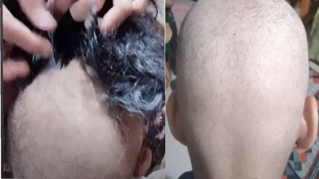 Buldhana Hair Loss Video : बुलढाण्यातील टकल्या लोकांच्या डोक्यावर केस पुन्हा आले पण आता 'या' नव्या आजारानं ग्रासलं Buldhana Hair Loss Video : बुलढाण्यातील टकल्या लोकांच्या डोक्यावर केस पुन्हा आले पण आता 'या' नव्या आजारानं ग्रासलं