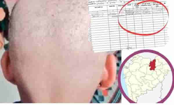 पाण्यामुळे नाही, फंगल इन्फेक्शन नाही...मग टक्कल पडतंय कसं? बुलढाण्यातील ग्रामस्थांना तपासण्यासाठी या राज्यांमधून डॉक्टर येणार