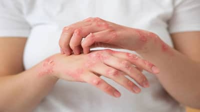 Psoriasis Skincare : लाल डाग, खाज आणि... हिवाळ्यात वाढू शकतो सोरायसिस; या टिप्स देतील आराम