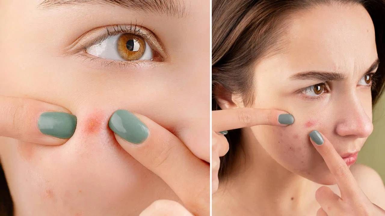 चेहऱ्यावर मुरुम कशामुळे होतात? रामबाण उपाय, जाणून घ्या चेहऱ्यावर मुरुम कशामुळे होतात? रामबाण उपाय, जाणून घ्या