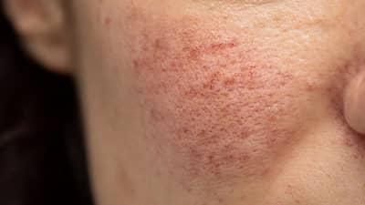 चेहऱ्यावर दिसणाऱ्या या लक्षणांवरून ओळखा लिव्हर झालेय खराब, दुर्लक्ष करणे पडू शकते महागात