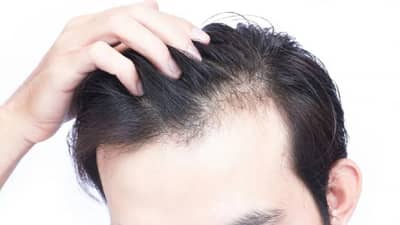 hair care:  पुरुषांमध्ये केस गळण्याचे हे ३ प्रमुख मोठी लक्षणे, दुर्लक्ष करू नका