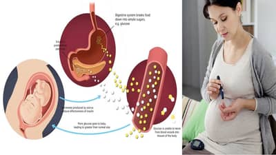 गरोदरपणात महिलांना जेस्टेशनल डायबिटीस का होतो? तो कायमचा राहतो का?