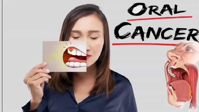 तोंडाचा कॅन्सर होणार की नाही? अवघ्या 15 मिनिटात कळणार; नागपुरातील प्राध्यापक आणि विद्यार्थ्याने लावला शोध