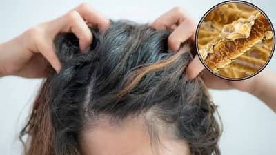 डैंड्रफ (Dandruff) पासून मुक्ती हवीय ? त्वरित करा हे उपाय