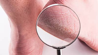 उन्हाळ्यातही टाचांना भेगा पडतात, या घरगुती उपायांनी मिळवा आराम