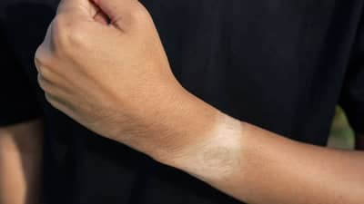 उन्हाळ्यात टॅनिंग होणार नाही, फक्त या गोष्टींची काळजी घ्या