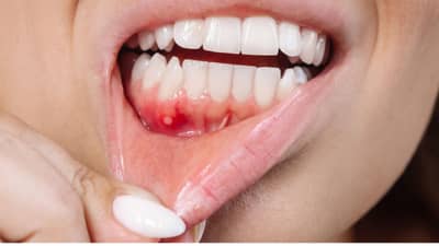 जर शरीरात ही लक्षणे दिसत असतील तर तोंडाचा कर्करोग असू शकतो; कसं ओळखाल?